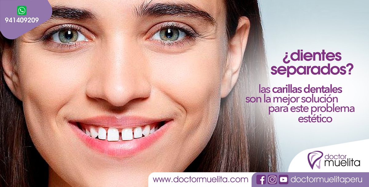CARILLAS DENTALES una buena alternativa para solucionar DIENTES SEPARADOS (Dientes con