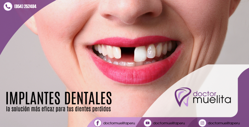 ¿Sábes como recuperar tus dientes perdidos?