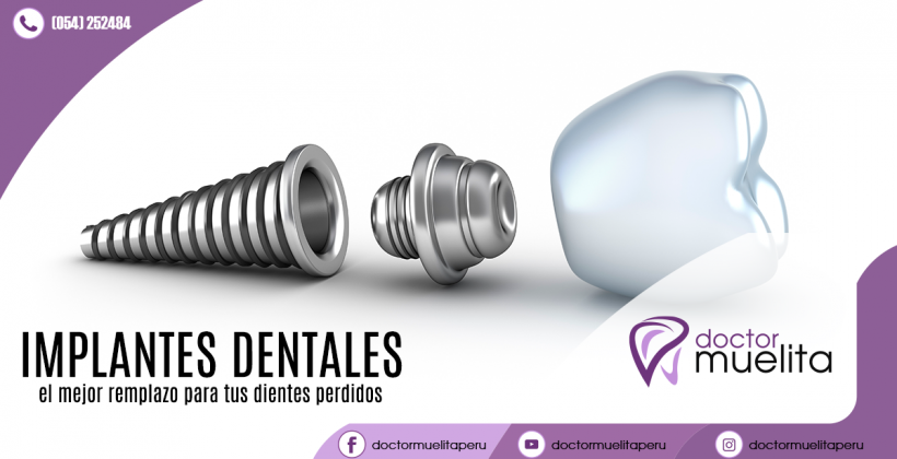 ¿Sábes qué es un implante dental?