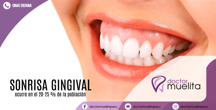 ¿Tengo una sonrisa gingival? ¿Tengo una sonrisa gingival?