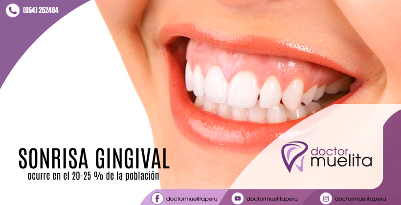 ¿Tengo una sonrisa gingival?