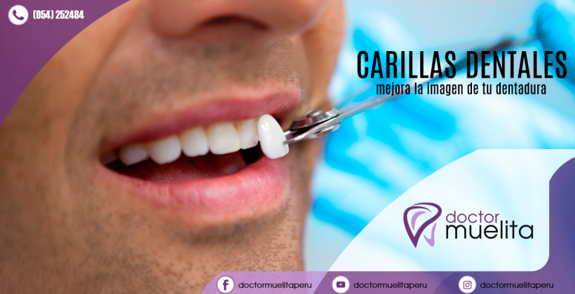 ¿Sabes qué son las carillas dentales y para que sirven? ¿Sabes qué son las carillas dentales y para que sirven?