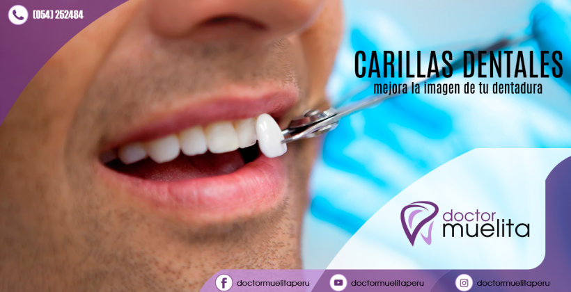 ¿Sabes qué son las carillas dentales y para que sirven?