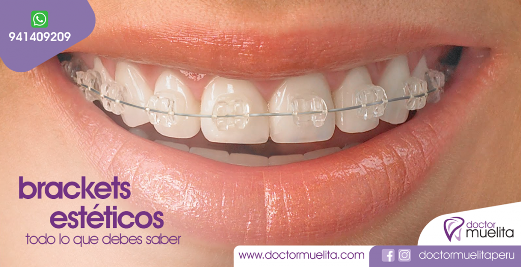 Todo lo que debes saber de los BRACKETS ESTÉTICOS Clínica Doctor Muelita