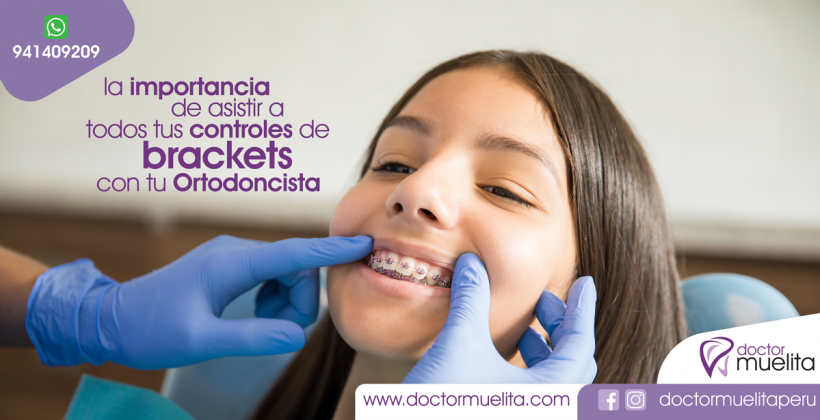 La Importancia de acudir a todos tus CONTROLES de BRACKETS con tu Ortodoncista