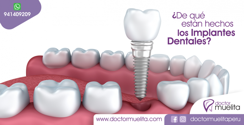 ¿De qué material están hechos los Implantes Dentales?