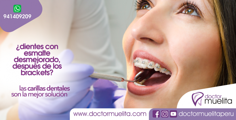CARILLAS DENTALES: La solución para dientes con ESMALTE DESMEJORADO después de la ortodoncia