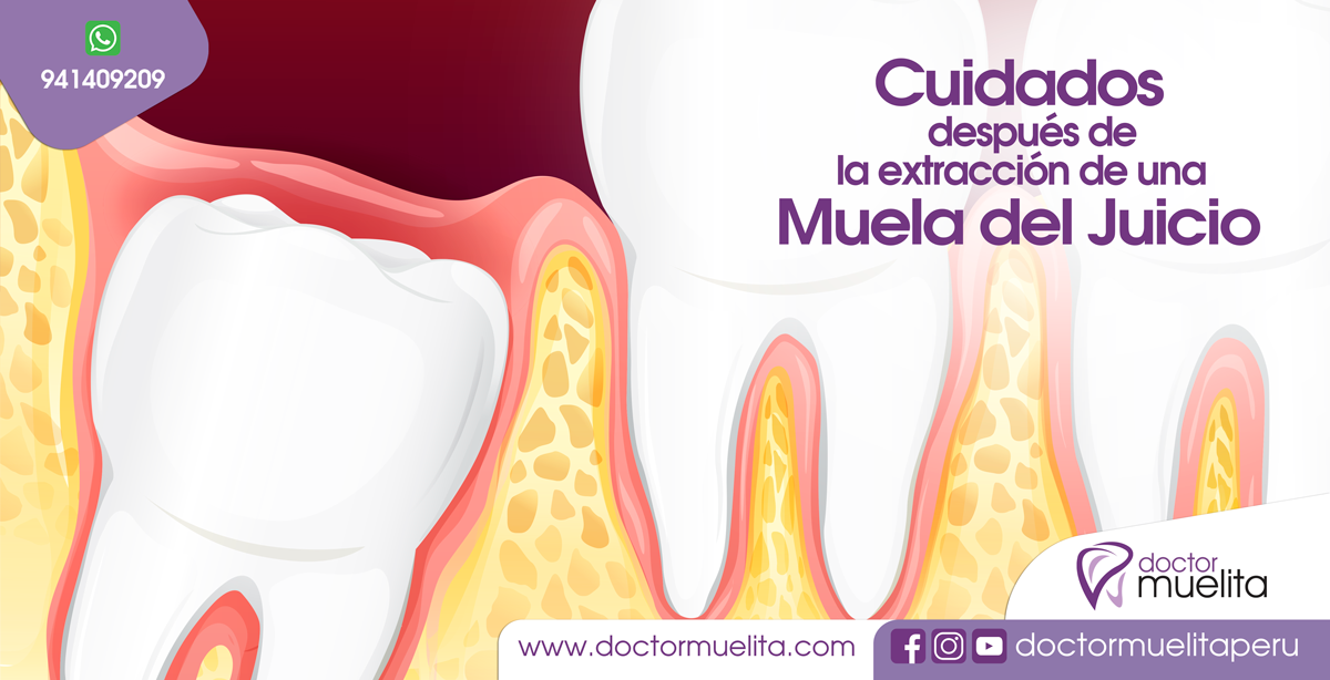 CUIDADOS que debes tener después de la extracción de una MUELA DEL