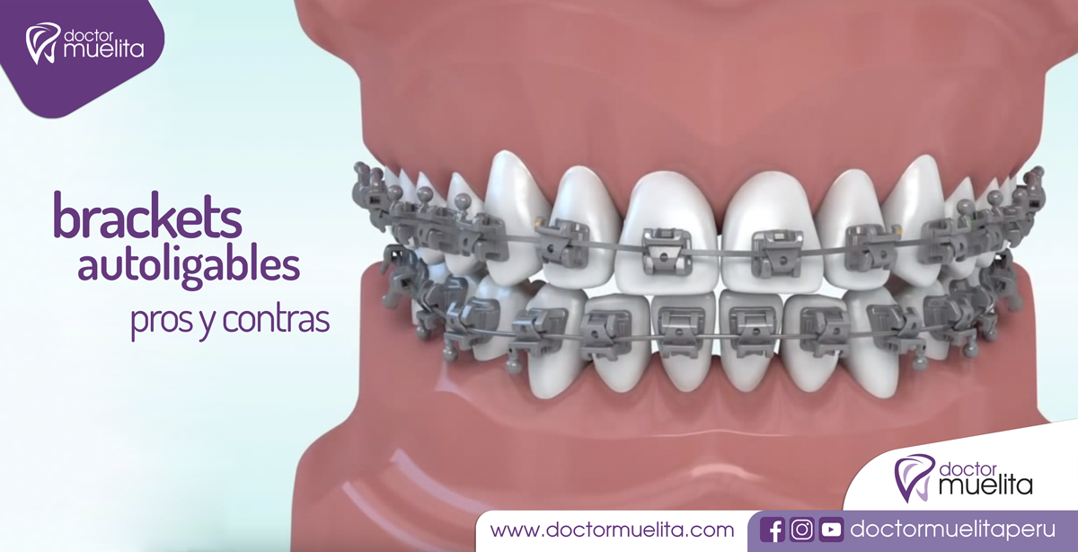 Conociendo los BRACKETS AUTOLIGANTES Clínica Doctor Muelita