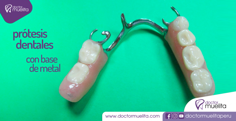 Prótesis Dentales con base de metal