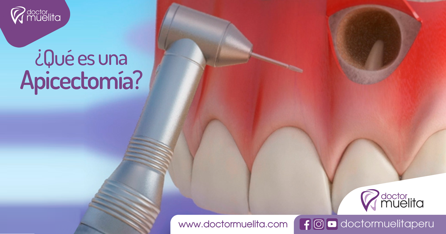 qu-es-una-apicectom-a-doctor-muelita