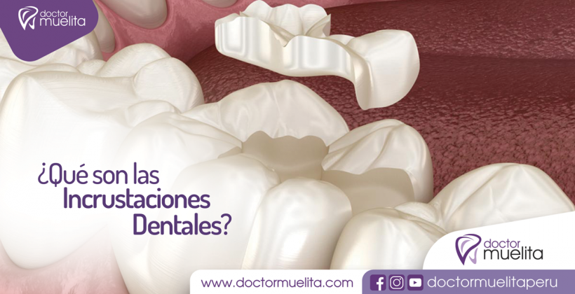 ¿Qué son las Incrustaciones Dentales?