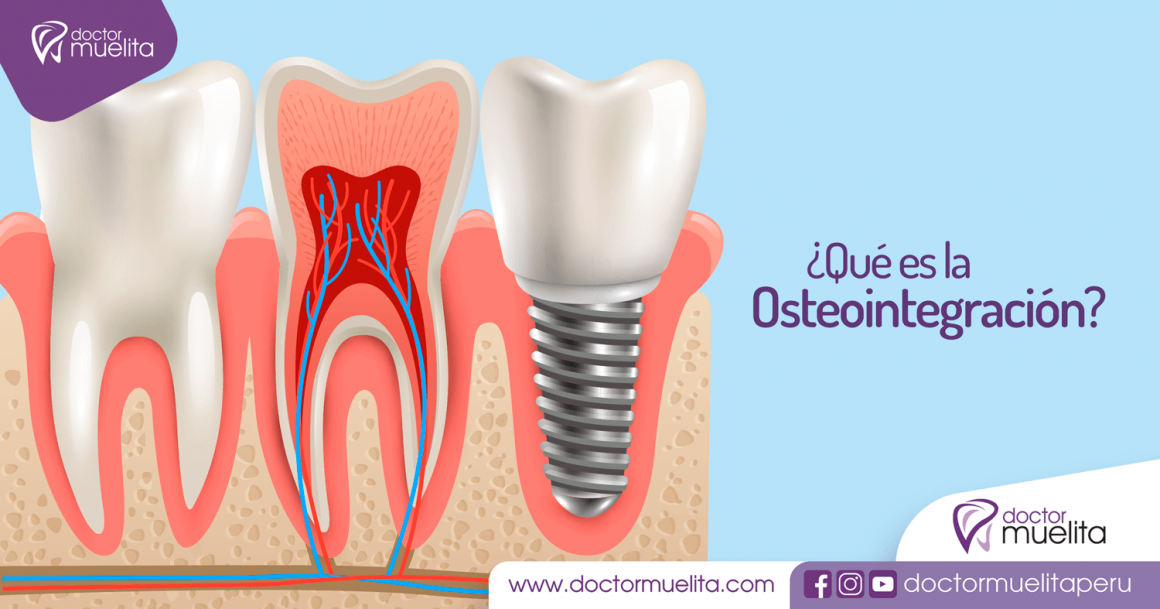 ¿Qué es la Osteointegración? Doctor Muelita