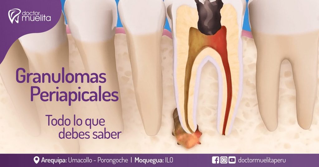 Granulomas Periapicales, todo lo que debes saber Clínica Doctor Muelita